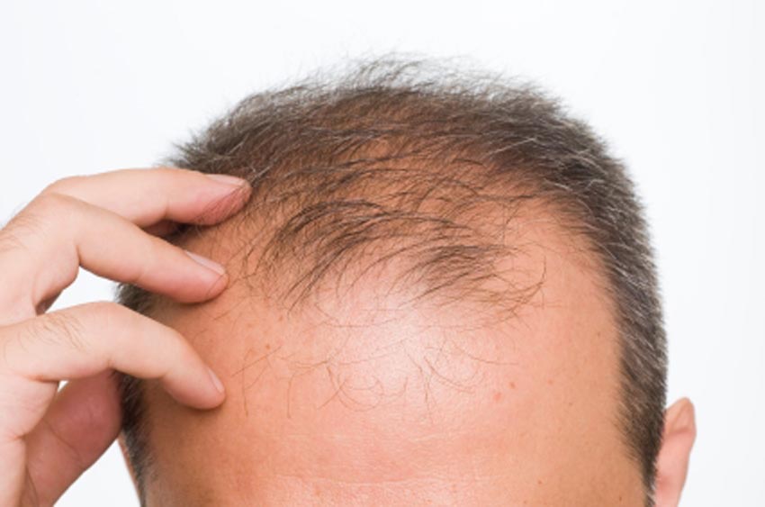 regrow lost hair natural way